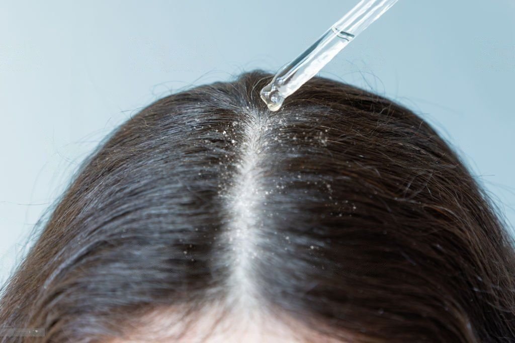 Dandruff Treatment
